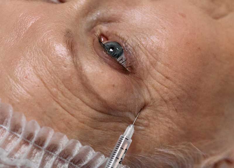 肉毒桿菌素如何減少皺紋 - 楊浩康醫生專業解讀