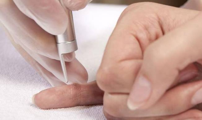 warts (疣) - 楊浩康醫生專業解讀