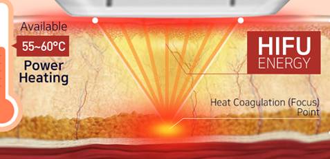 HIFU如何收緊肌膚 - 楊浩康醫生專業解讀